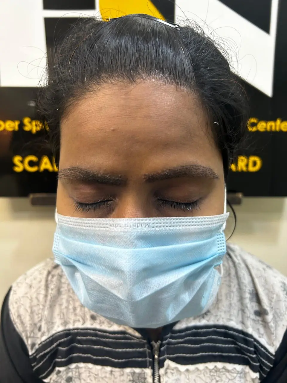 High-Density Eyebrow Restoration
