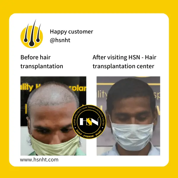 Scalp Restoration Before & After