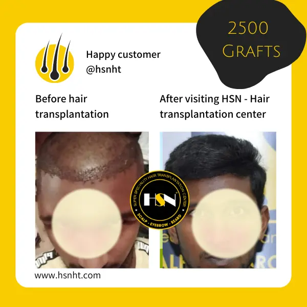 Frontal Hair Restoration Before & After