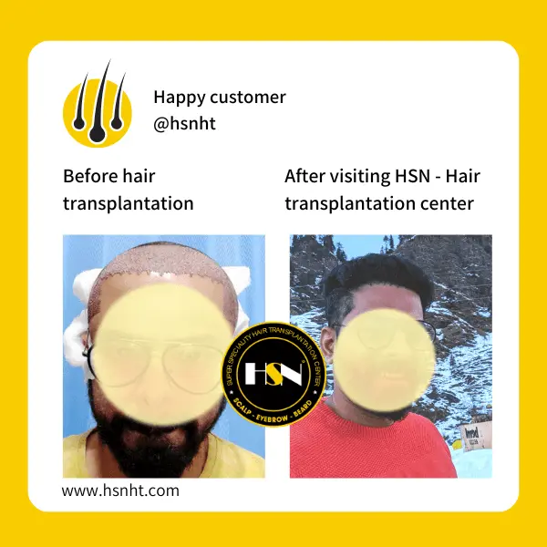 Full Scalp Restoration Before & After